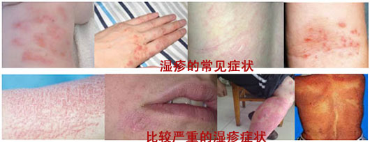 湿疹症状